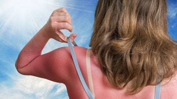 Sunburn SOS: 7 tips to soothe your sun-damaged skin, according to a wellness expert